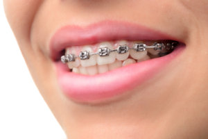 Nahaufnahme der Zähne mit Zahnspangen